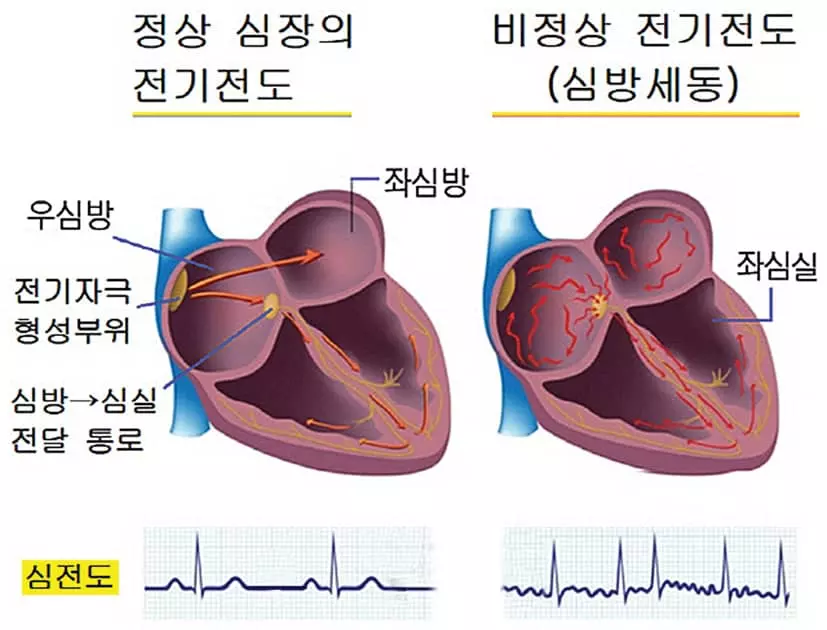 부정맥-심장이 제멋대로 쿵쾅… 뇌졸중‘위험신호’