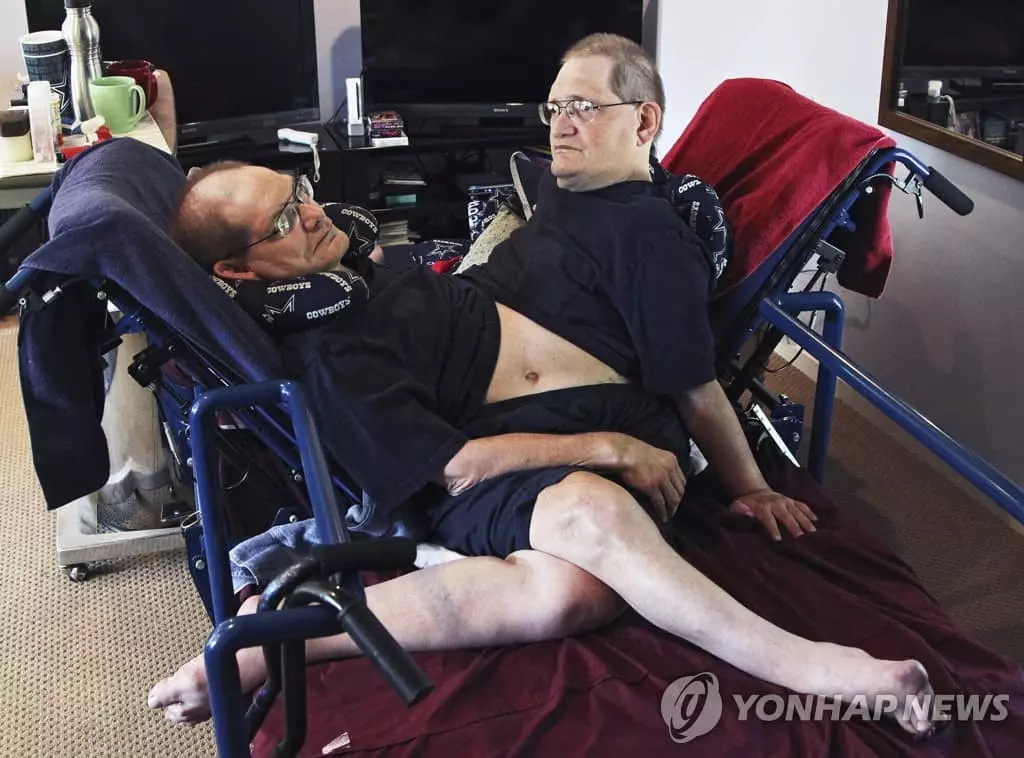 세계 최장수 몸 붙은 쌍둥이 68세 일기로 사망