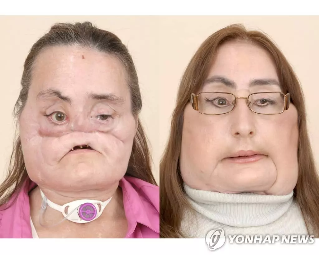미국 첫 얼굴 전체 이식 여성 12년만에 사망
