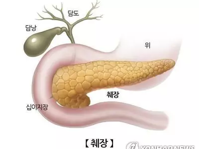 "췌장 지방 과다, 뇌 건강과 관계있다"