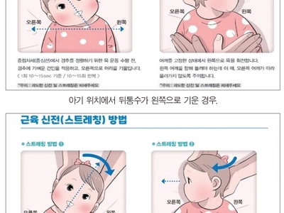 기울어진 아기 목…‘사경’‘측경’오인해 잘못된 재활운동 많아