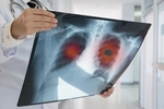 암 사망률 1위는 ‘폐암’… 조기발견 못하면 80%가 사망