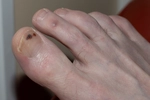 손·발톱에 생긴‘점’… 갑자기 커지면‘피부암’의심해야