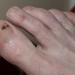 손·발톱에 생긴‘점’… 갑자기 커지면‘피부암’의심해야