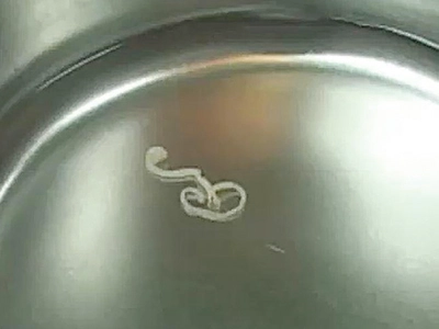 뇌종양인 줄 알았더니 뇌에 기생충이 ‘꿈틀’