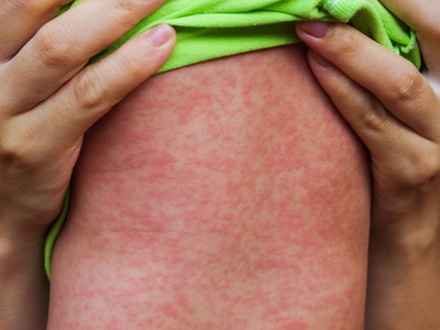 조지아 올해 첫 홍역 확진자...백신 접종 촉구