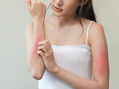 ‘아토피 피부염’… 다양한 면역 경로로 인해 유발돼