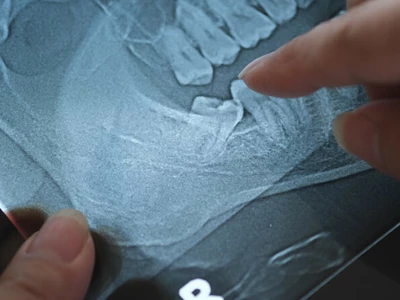 “아프지 않은데… 사랑니 지금 꼭 뽑아야 하나”