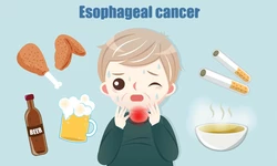 뜨거운 커피·국물 좋아하세요?… 자칫 식도암 위험