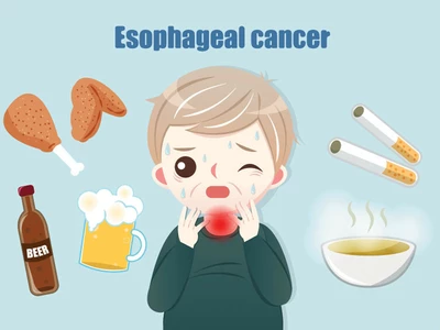 뜨거운 커피·국물 좋아하세요?… 자칫 식도암 위험