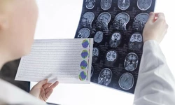 간단한 혈액검사로 알츠하이머를 예측할 수 있을까