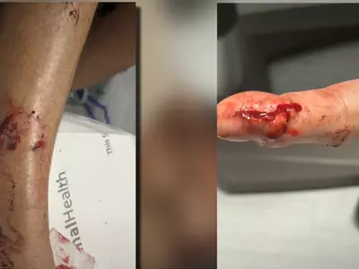 광견병 코요테, 귀넷서 잇따라 주민 공격