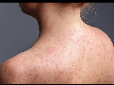 조지아서 또 홍역 확진 환자