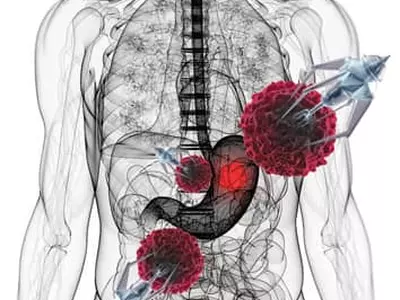 악성 의심 ‘점막 밑 종양’ 복강경 수술없이도 특수 내시경으로 손쉽게 제거