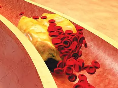 ‘나쁜’ LDL콜레스테롤 160㎎/㎗ 이하로 낮춰라