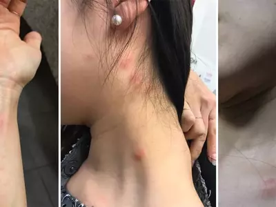 호텔 투숙 한인여성 벌레에 물렸는데....