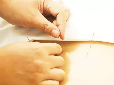 침으로 경락 자극… 요통·관절염 큰 효과