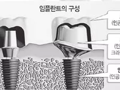 임플란트 공공의 적 '잇몸염증'