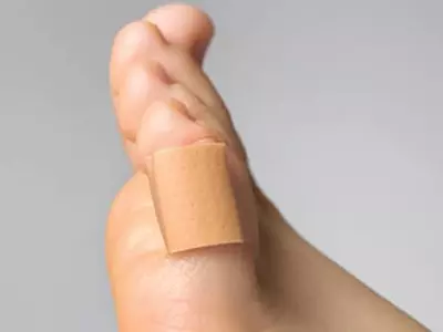 살 파고드는 내향성 발톱 일자로 깎고 신발 넉넉하게