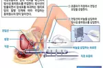 ‘MRI와 초음파 영상 융합치료’ 초기 전립선암 시술에 새 장