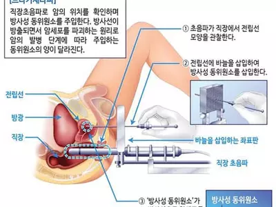 ‘MRI와 초음파 영상 융합치료’ 초기 전립선암 시술에 새 장