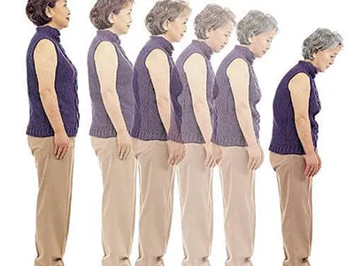 뼈 숭숭… 삐끗 넘어져도 노인에 치명적