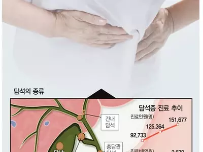 콕콕콕 쑤시는 복통… 몸속에 생긴 돌 때문?