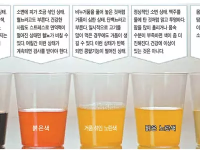 소변이 붉은색이면 방광염·콜라색은 사구체신염 의심을