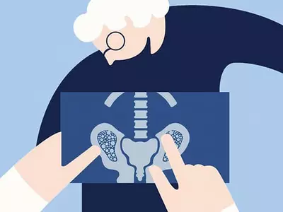 골밀도 검사 ‘65세 이상 모든 여성’받아야