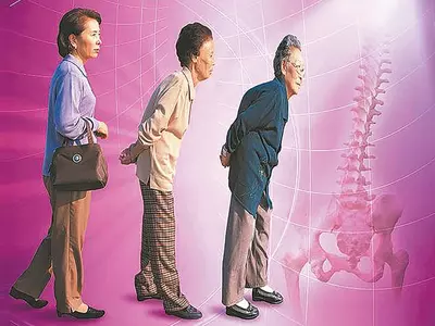 ‘조용한 도둑’ 골다공증  막으려면 칼슘 섭취와 운동이 묘약