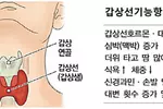 스마트워치로 갑상선기능항진증 조기 판별