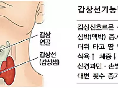 스마트워치로 갑상선기능항진증 조기 판별