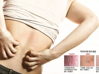 만성환자 3년새 35%상승 ... 도드라진 두드러기