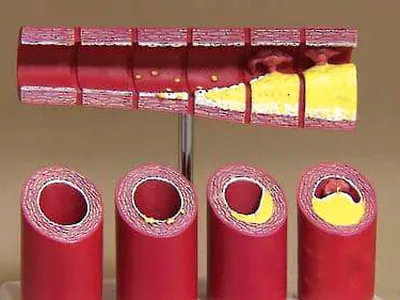 중성지방 높다는데 어떡하나