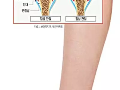 류마티스관절염, 男보다 女 더‘욱신’