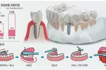 임플란트, 잇몸 염증 못 잡으면 ‘모래성’