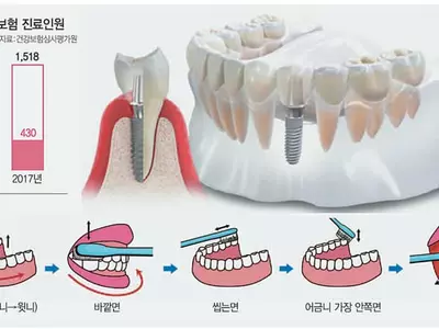 임플란트, 잇몸 염증 못 잡으면 ‘모래성’