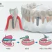 임플란트, 잇몸 염증 못 잡으면 ‘모래성’