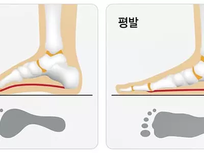 평발  19세 미만이 72%… 성장하면서 대부분 좋아져