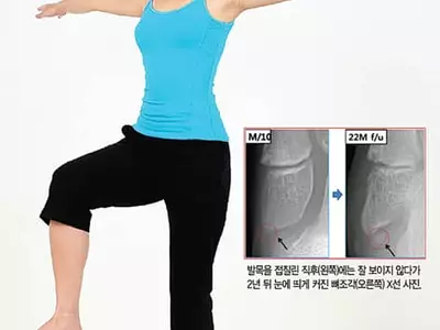 발목 삐끗한 소아청소년 40%가 ‘뼛조각 합병증’