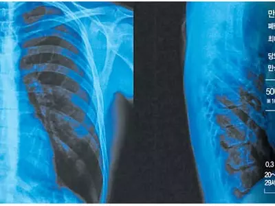 폐암보다 무서운 폐렴… 노인엔 치명적