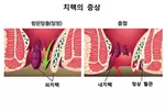 화장실 용무 5분 내 마치고 배변 과도한 힘 주지 말아야