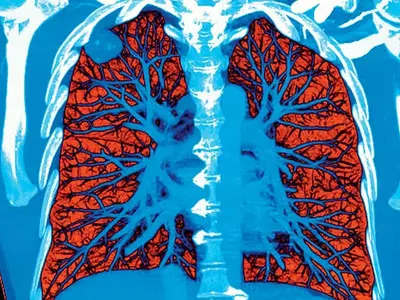 AI 폐암 진단능력, 의사보다 나은‘A+’