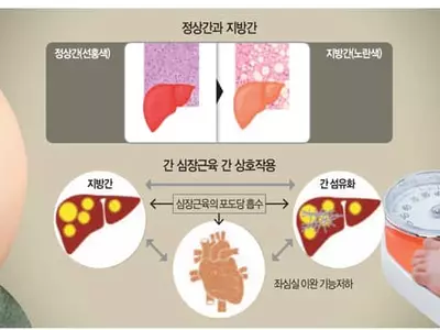 지방간염, 체중 안 줄이면 간경변 된다