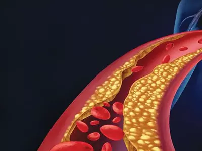 증상 없는 고콜레스테롤, 뇌졸중 위험 40% 높다