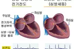 부정맥-심장이 제멋대로 쿵쾅… 뇌졸중‘위험신호’
