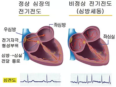 부정맥-심장이 제멋대로 쿵쾅… 뇌졸중‘위험신호’