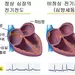 부정맥-심장이 제멋대로 쿵쾅… 뇌졸중‘위험신호’