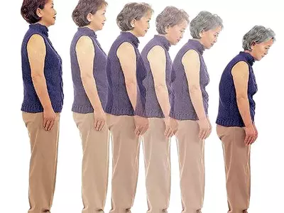 골다공증 환자 급증…“중년 여성이라면 꼭 검사를”