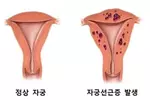 난임여성 10명중 1명 갑상선·부인과 질환